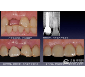 門(mén)牙即刻種植、即刻修復(fù) 避免缺牙尷尬