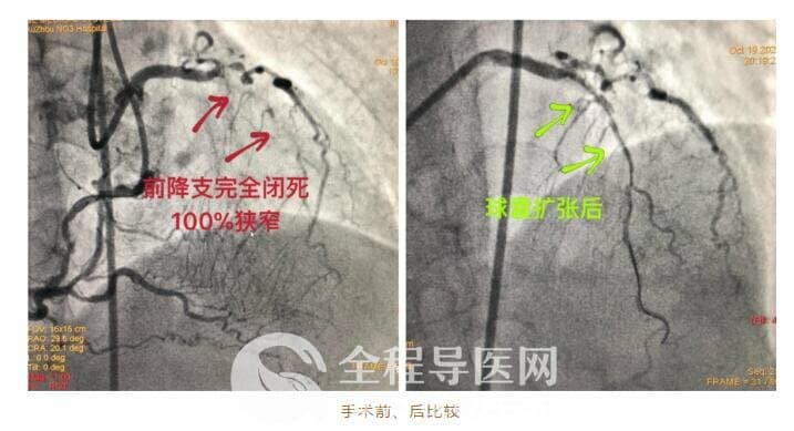 徐州市三院心臟團隊于長城心臟病學(xué)大會CTO論壇直播超高難度冠心病介入手術(shù)