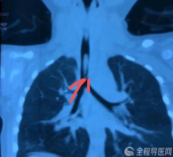 1歲9月因吃葵花子被卡住 徐州兒童醫(yī)院接診多起氣管異物～